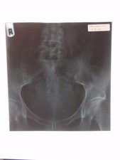 Pelvis Spine X-Ray British School Osteopathy Medical Anatomical 1970 VTG Photo