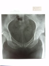 Pelvis X-Ray British School Osteopathy 1971 Medical Anatomy Photo