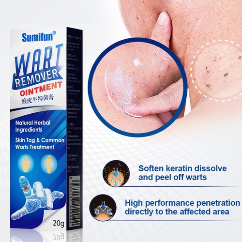 Sumifun wart removal - wart, body