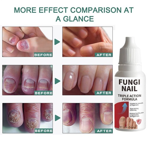 Fungi nail anti fungal - anti, liquid