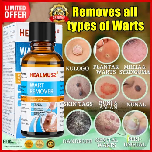 Wart remover liquid fast - wart,