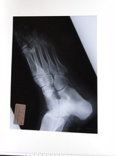 British School Osteopathy X-Ray Human Foot Bones Dalzell 1972 VTG Photo