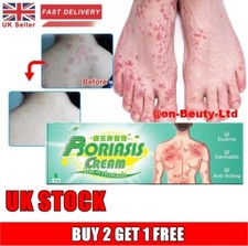 UK Skin Psoriasis Cream Dermatitis bacteriostatic Itching dryness Cream Redness