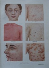 Vintage Anatomical Print: Eruptive Fevers, The Household Physician, 1935