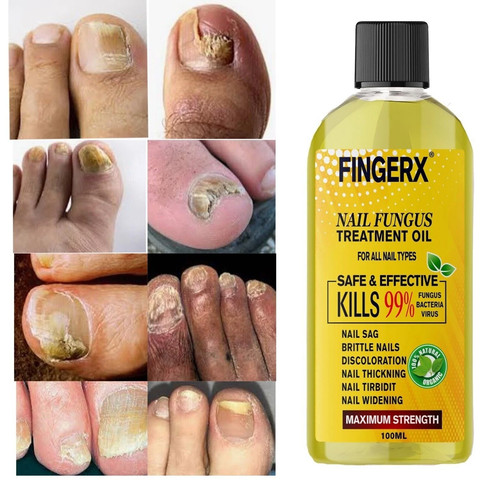 100ml anti fungal treatment - 100ml,