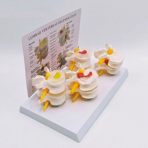 Sick human lumbar model - human,