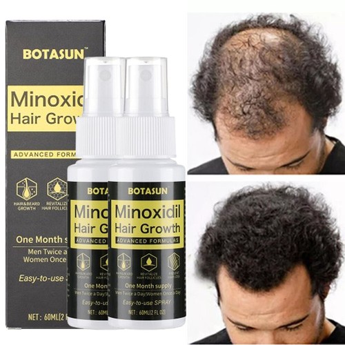 Minoxidil extra strength - minoxidil,