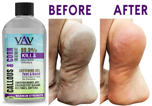 Best callus remover - best,