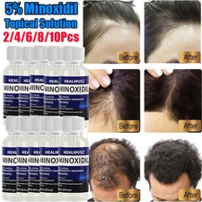 Months minoxidil extra - 2-10,