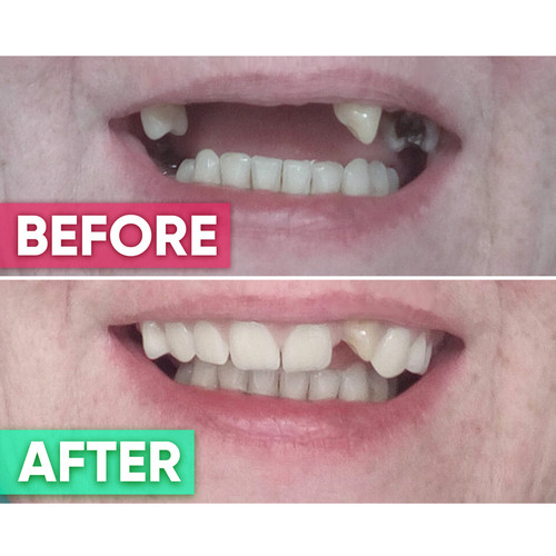 Diy denture kit with - kit,