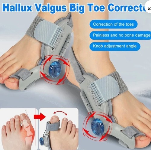Hallux valgus bunion - 2,