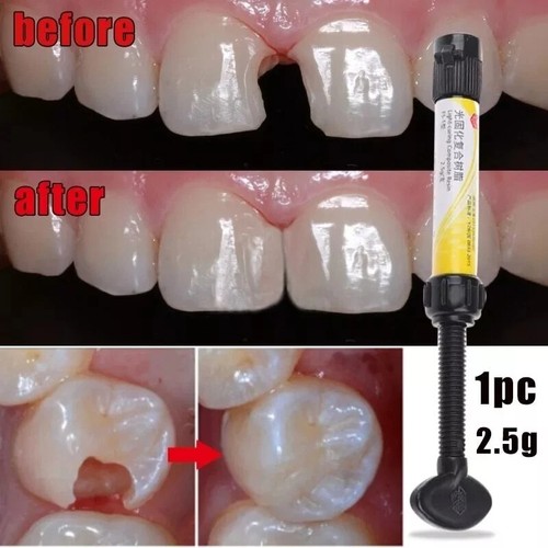 Dental cement teeth - dental,