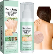 Acne Treatment Spray for Body