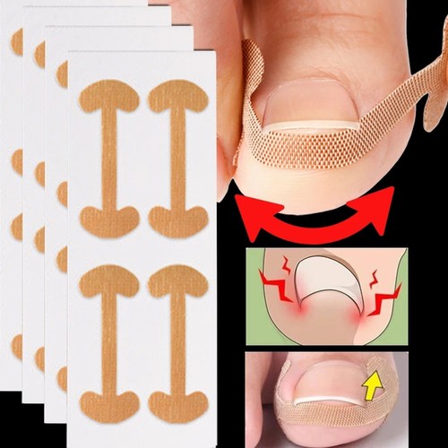 100pcs ingrown toenail - ingrown,