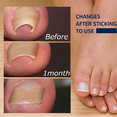 50x ingrown toenail sticker - ingrown,