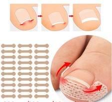 20PC Ingrown Toenail Corrector
