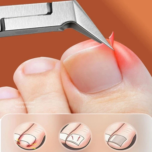 Ingrown toenail clipper thick - toenail,