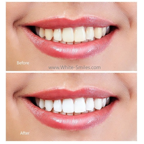 Very strong teeth whitening - strong,