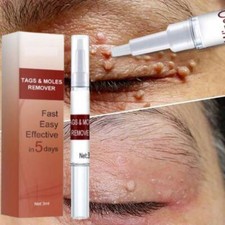 Skin Tags & Moles Removal