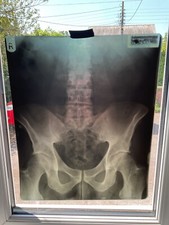 3 x Vintage X Ray Medical Body Hip Rare X Ray  Negative Photo = 1973