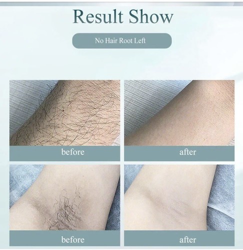 Ipl quality laser hair - ipl,