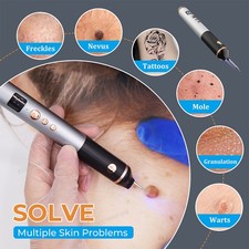 15 Level Laser Plasma Pen Mole