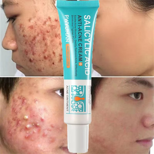 Salicylic acid strong - strong, acne