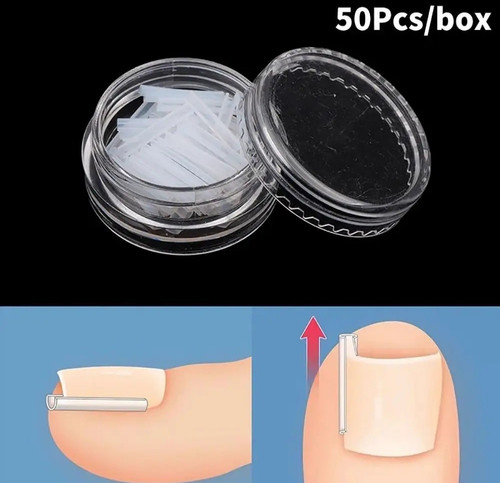50pcs ingrown toenail - ingrown,
