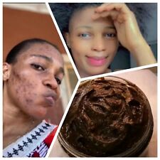 Pimples, Acne, Sun Burn, Spot