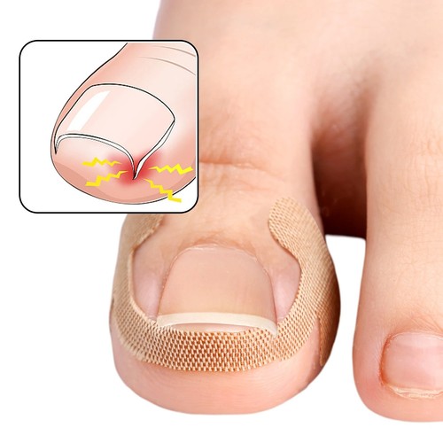 100pcs ingrown toenail - ingrown,