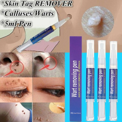 3packs hours wart - 3packs, remover