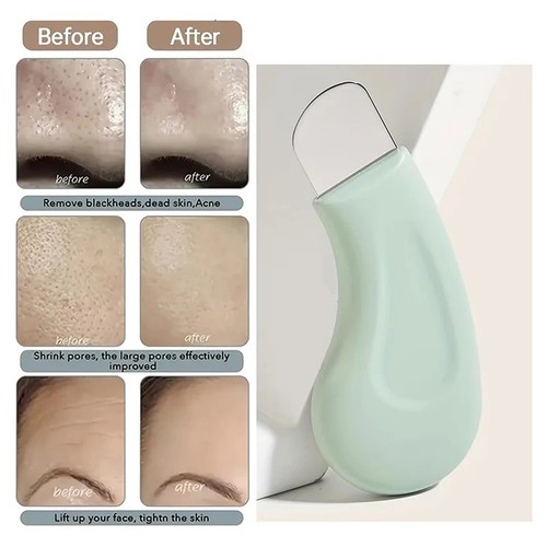 Blackhead remover handheld - remover,