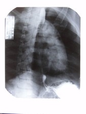 Medical X-Ray British School Osteopathy Chest Spine Barium 1972 VTG Photo