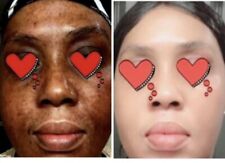 FAST Skin Whitening Bleaching