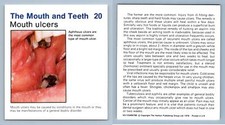 Mouth Ulcers #20 Mouth & Teeth Home Medical Guide 1975-8 Hamlyn Card