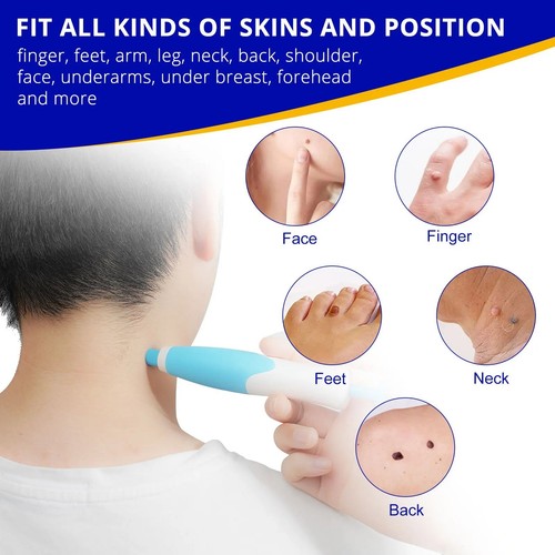 Auto micro skin tag remover - micro,