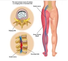 Sciatica Pain Oil Massage