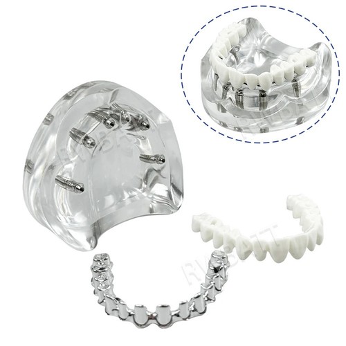 Dental implant model upper - model,