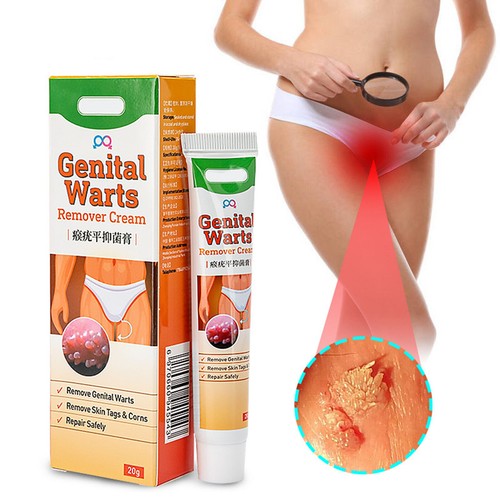 Genital herpes wart - genital,