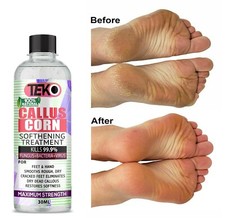 CALLUS REMOVER Hard Dead Skin CORN Treatment Quick Fix Pedicure FOOT GEL