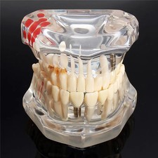 Dental implant model teeth - dental,