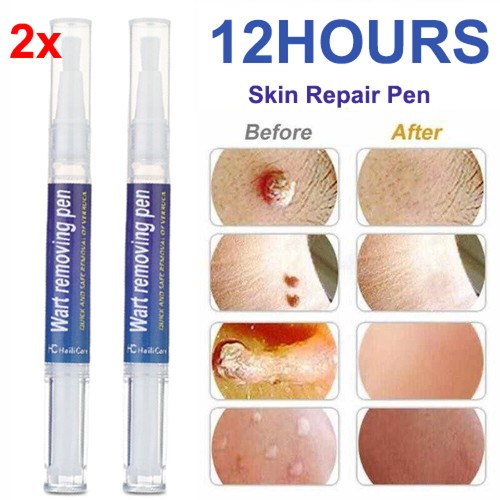 5ml skin tag remover - 2x,