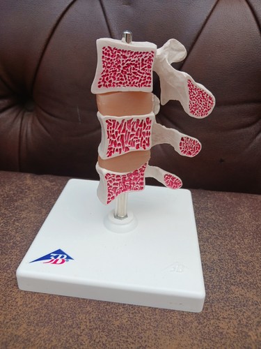 Human anatomy osteoporosis - 3b,