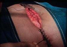 Rare 16mm Magnetic Sound Medical Reel: ‘Trans-Thoracic Splenectomy’ (1960s)