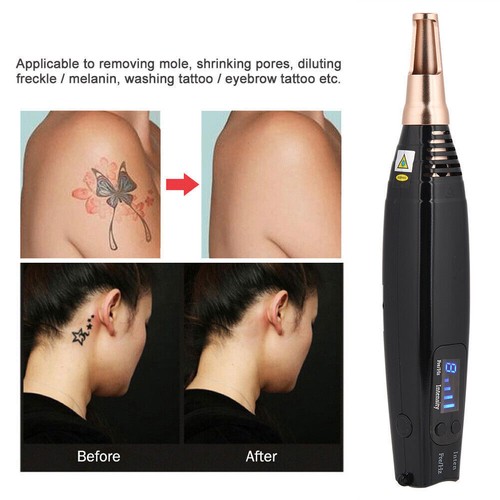 Tattoo laser scar spot removal - spot,