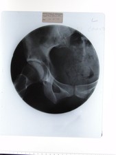 Medical X-Ray Pelvis Hip Joint British School Osteopathy 1970 Celluloid Photo