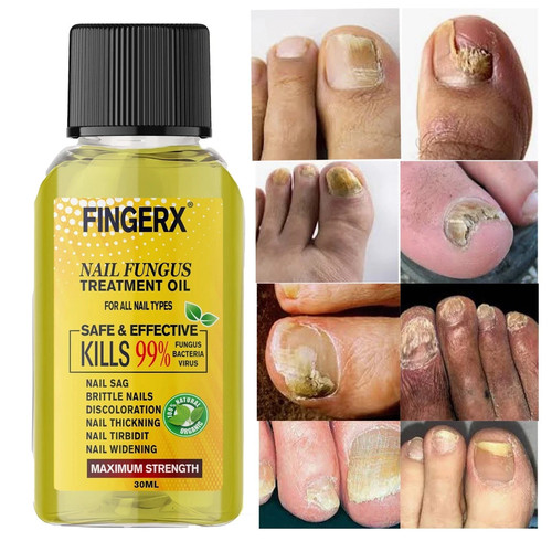 30ml fungal nail treatment - 30ml,