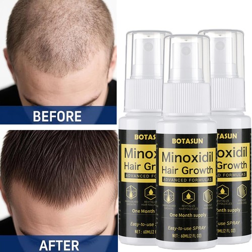 Minoxidil hair growth spray - 5%,