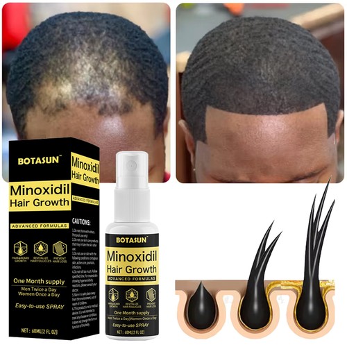 Minoxidil hair regrowth - hair,