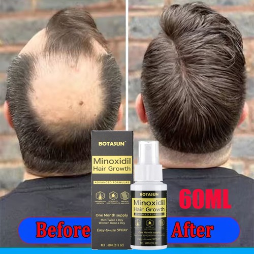 Minoxidil extras strength - 5%,
